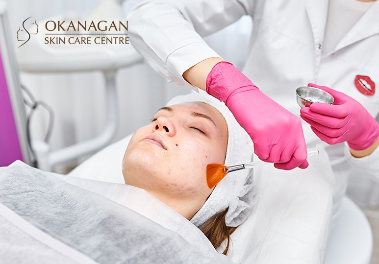Okanagan Skin - Have Acne Scars - Try Chemical Peels